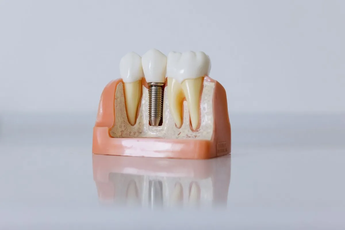 A model showing a dental implant beside natural teeth